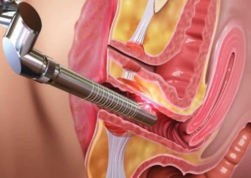 Vaginal Tightening image