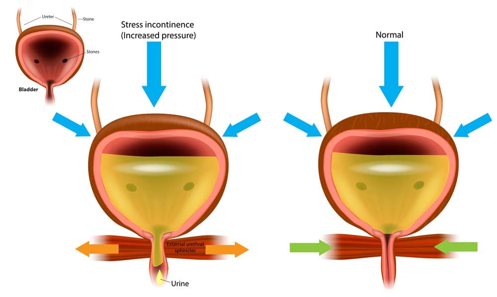 Stress Urinary Incontinence (SUI)