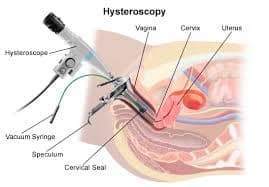 Office Hysteroscopy