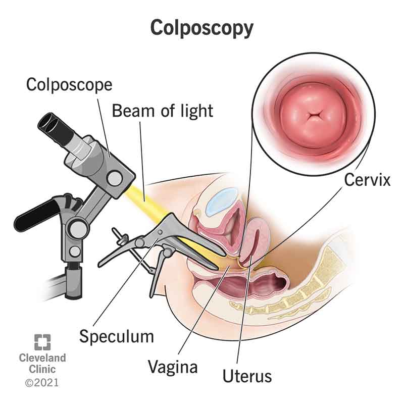 Colposcopy
