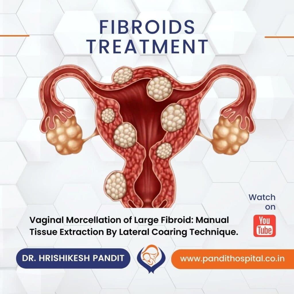Fibroid Management