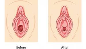 Post-Delivery Vaginal Restoration image