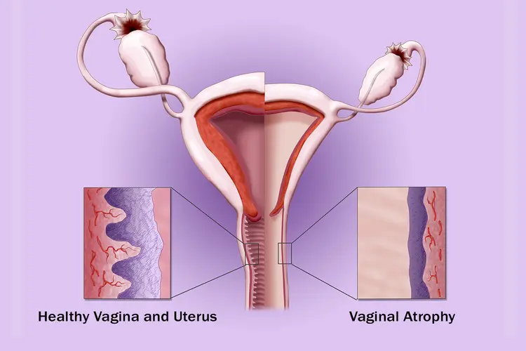 Vaginal Dryness Treatment image
