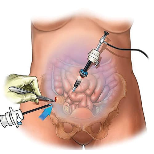 What Are Gynaecologic Cancers?