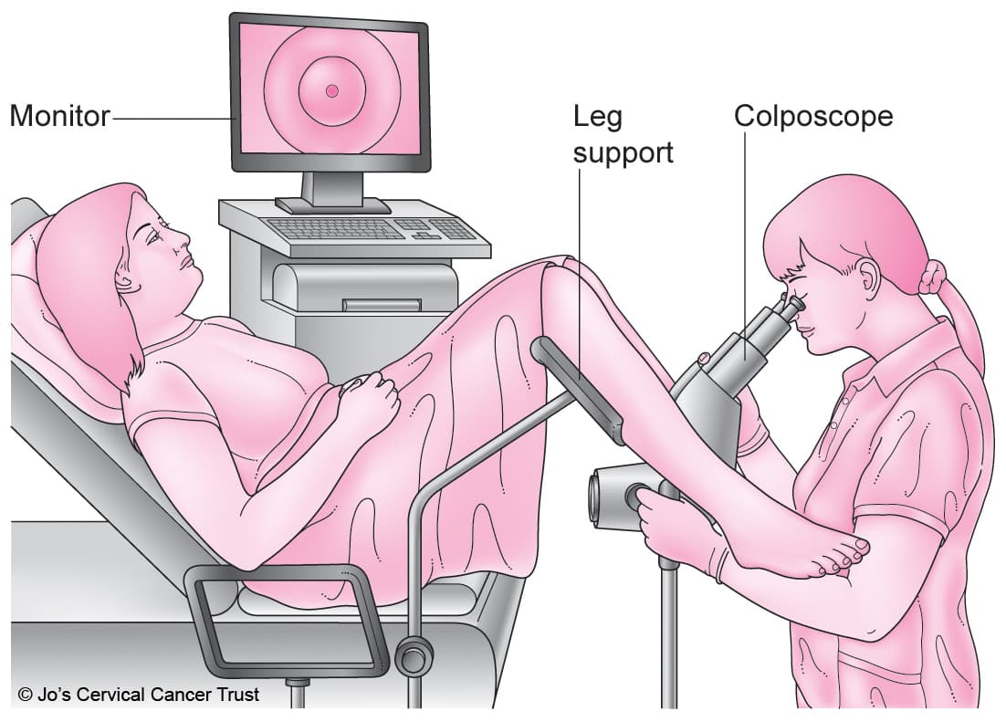 What is Colposcopy?