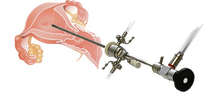 What is a Hysteroscopy?