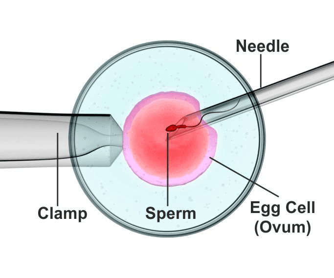 About ICSI Treatment