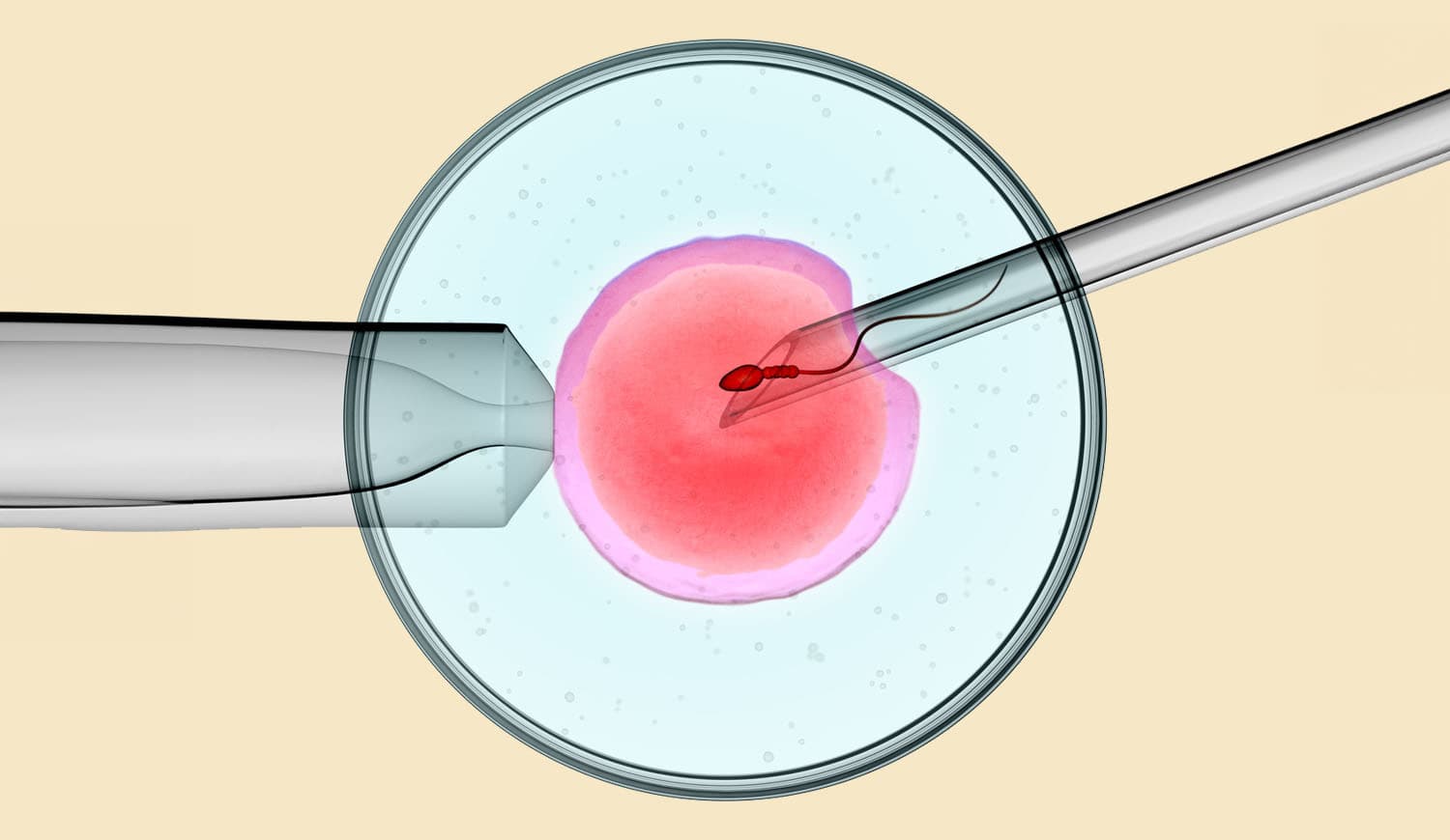 About IMSI Treatment